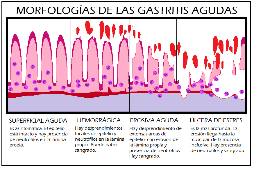 gastritis cronica superficial profunda